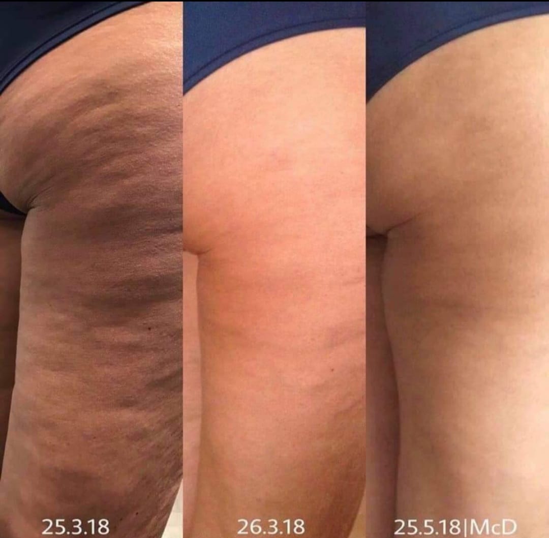 cellulite krém2